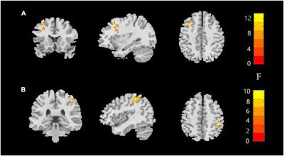 Intrinsic brain abnormalities in female major depressive disorder patients with childhood trauma: A resting-state functional magnetic resonance imaging study